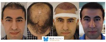 E' possibile pagare a rate il costo del trapianto capelli, trapianto capelli: Cresce Il Ricorso All Autotrapianto Dei Capelli Gosalute