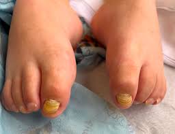 Image result for Yellow nail syndrome feet