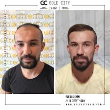 Hatip Altinkaynak 15 Ay 4600 Greft