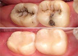 Composite Fillings In New Delhi White Tooth Coloured Fillings Dental Composite Resin Teeth Fillings In Delhi Dental Composite Dental Fillings Happy Dental