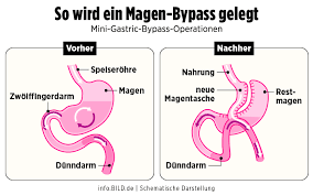 Reiner calmund präsentiert sein neues ich. Reiner Calmund Nach Magen Verkleinerung Sein Arzt Ist Emport Bildplus Inhalt Fussball Bild De