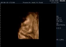 Spürt das baby den ultraschall? 3d 4d Ultraschall Frauenarzt Saarlouis Dr Daub