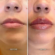 Albuquerque Lip Filler Before & After Gallery: Chrome Aesthetics