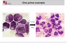 Image result for Hematologic Cancer