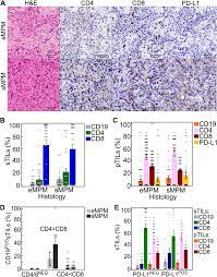 The average life expectancy is about one year, but patients who are diagnosed early and elect treatment may live for several years. Characterization Of The Immune Microenvironment In Malignant Pleural Mesothelioma Reveals Prognostic Subgroups Of Patients Lung Cancer
