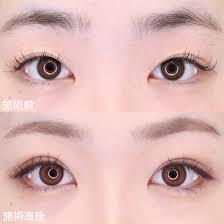 安定しない二重線…【埋没法】でクッキリ華やかな二重に！｜症例写真・ビフォーアフター｜美容整形・美容外科のTAクリニックグループ