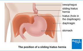 But a large hiatal hernia can allow food and acid to back up into your oesophagus, leading to heartburn. Hiatus Hernia Health Information Bupa Uk