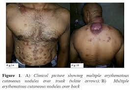 There is no sign that the cancer has spread outside of the colon or rectum. Cutaneous Metastases From Colon Carcinoma An Unusual Presentation