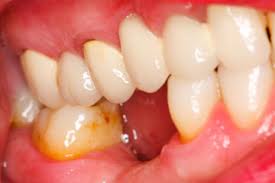 Image result for Gingivitis