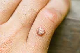Your doctor may shave off dead skin on the wart area with. Can Treating Warts Do More Harm Than Good