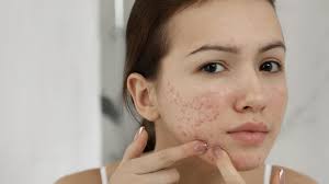 Best Acne Doctor in Marietta, Georgia