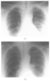 Segmental diagram of lung anatomy. Https Www Clinicalradiologyonline Net Article S0009 9260 89 80119 9 Pdf