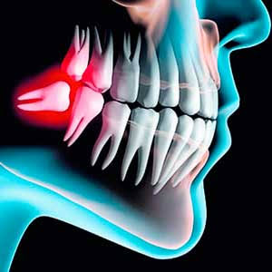Extracción de Tercer Molar
