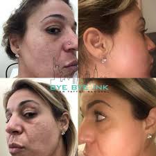 Here's what you should know before booking a tattoo removal 2. Before And After Bye Bye Ink