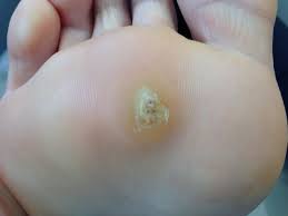 We did not find results for: Warts Treatment Removal Foot Ankle Specialty Group Beverly Hills