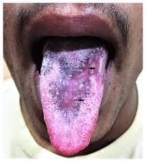 Image result for lichen planus on tongue)