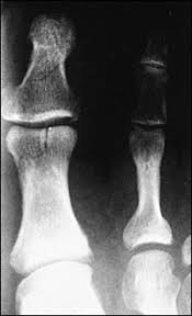 A proximal phalanx fracture splint is needed when your fingers got a fracture. Evaluation And Management Of Toe Fractures American Family Physician