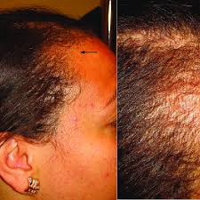 These are the side effects of lexapro you should be on the lookout for ssris in general have the potential to cause sexual side effects, like taking longer to reach orgasm and decreased desire, explains anderson. Topical Interferon Alopecia Left Hair Loss Arrow From Cranium Is Download Scientific Diagram