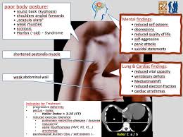 Image result for Pectus Excavatum