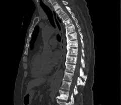 Some people also refer to it as bone metastases or if you haven't been diagnosed but are worried about a symptom, find out more about the signs and symptoms of secondary breast cancer. Vertebral Metastases Breast Carcinoma Radiology Case Radiopaedia Org