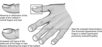 Asterixis (also called the flapping tremor, or liver flap) is a tremor of the hand when the wrist is extended, sometimes said to resemble a bird flapping its wings. Jaypeedigital Ebook Reader