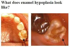We're here to correct any misconceptions and reassure you that this condition is quite treatable. Enamel Hypoplasia Is A Defect Dental Technologist Club Facebook