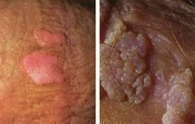 Image result for genital warts