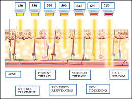 For ipl hair removal to work effectively, some hair is required to allow the light to target it, so it's best not to wax or epilate before your session. About Ipl Treatments Hair Removal Ipl Beachside