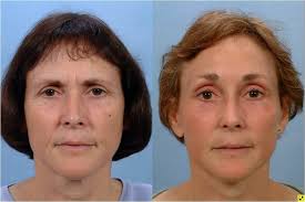 Recovery time takes around two weeks to a month. Facelift And Mini Facelift Johns Hopkins Facial Plastic And Reconstructive Surgery