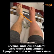 Image result for erysipel photos)