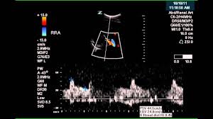 Renal Artery Doppler Case Study Vascular Ultrasound Renal Arteries
