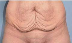 Addressing Loose Skin Taking Advantage Of Rapid Weight Loss And Postpartum Hormones To Shape Body After Baby
