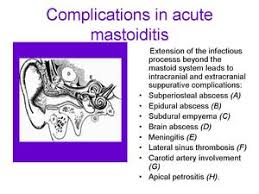 Image result for Mastoiditis