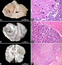 This tumor tends to grow as a large, single, and solitary mass, but may spread within the lungs, to local lymph nodes, or even bone. Scielo Brasil Pathological Features Of 78 Metastatic Or Multicentric Neoplasms Involving The Central Nervous System In Dogs Pathological Features Of 78 Metastatic Or Multicentric Neoplasms Involving The Central Nervous System In Dogs