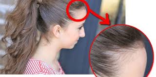 Alopecia por tracción: cómo