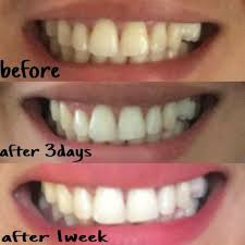 Pin On Teeth Whitening