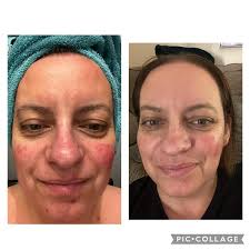 I had the most fabulous facial with Vicki after having my eyebrows tinted  which she made a wonderful job of. Vicki tailored the facial to my skin  using the exquisite Tropic products