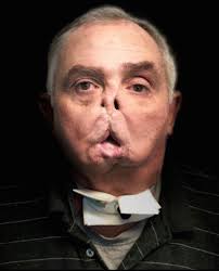 Face transplantation: anesthesia and other organizational considerations