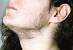 Woman Laser Hair Removal Chin