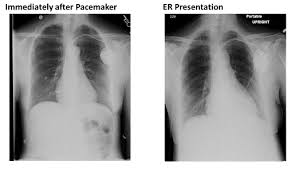 Chest Pain After Pacemaker Implantation American College Of Cardiology