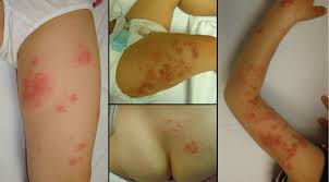Image result for shingles in children