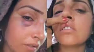 Seema Haider assaulted? Viral video shows her with bruised lip, eye. What  happened? | Latest News India - Hindustan Times