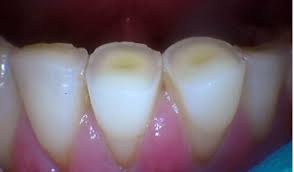 But in addition to grinding or clenching your teeth while you sleep, there can be other symptoms. The Top 5 Signs That You Clench Or Grind Your Teeth