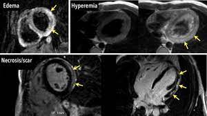 Cardiac magnetic resonance imaging (mri) is an established imaging modality, well recognized for its value in the initial assessment and monitoring of a wide range of diseases of the heart and. Cardiac Magnetic Resonance Assessment Of Myocarditis Circulation Cardiovascular Imaging