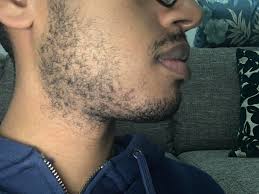 See more ideas about hair pulling, hair, hair styles. 14 Days Of Growth At 23 Y O Any Advice On How To Stop Myself From Pulling Hair Out It Started When I Kept Thinking I Ll Never Grow A Proper Beard Which Could