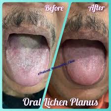Image result for lichen planus on tongue)