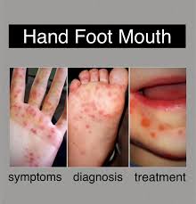 Image result for Hand foot and mouth disease HFMD roof of mouth