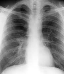 Image result for Emphysema