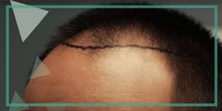 Trapianto capelli fue senza rasatura capelli. Trapianto Di Capelli Dhi Senza Rasatura Znz Grup