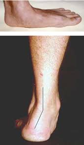 Sample Marfan Syndrome Images